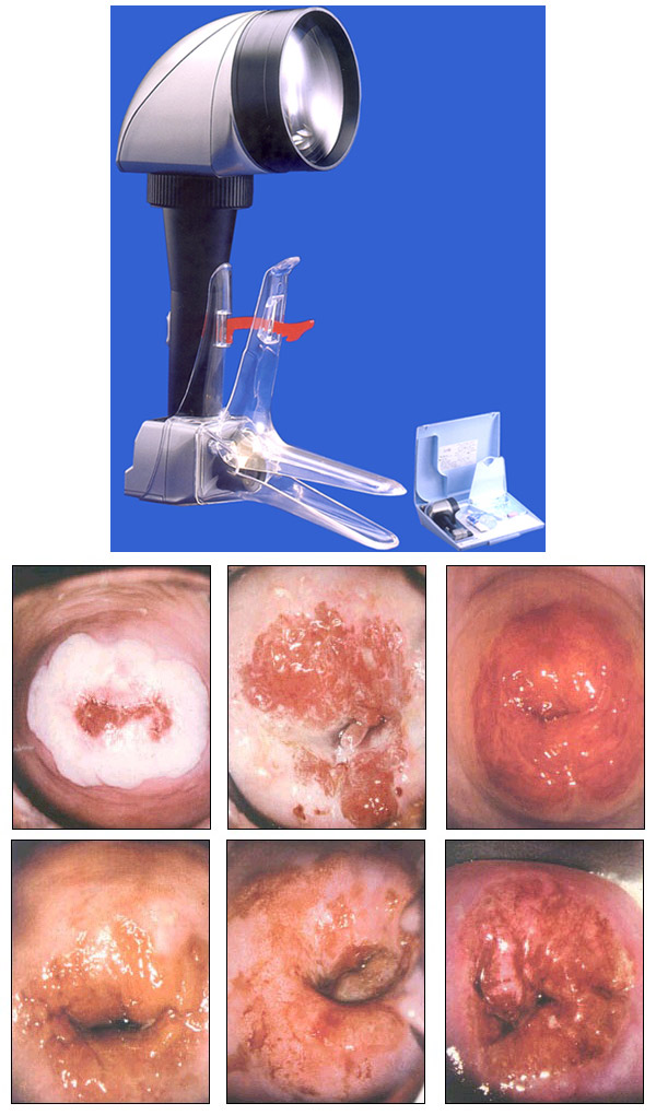 cervical cryosurgery